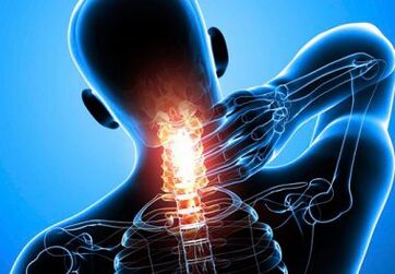 intenzivní bolest krku s pokročilou osteochondrózou