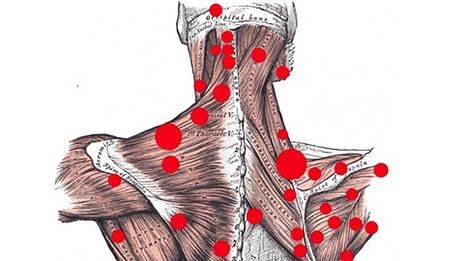 Spouštěcí body ve svalech, které vyvolávají myofasciální bolesti zad