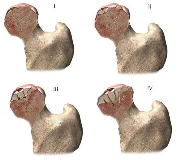 stadia artrózy kyčelního kloubu