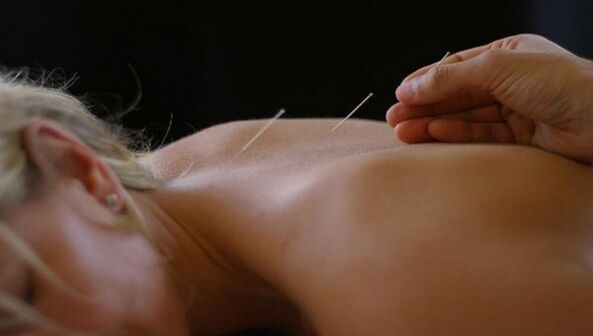 akupunktura na bolesti zad