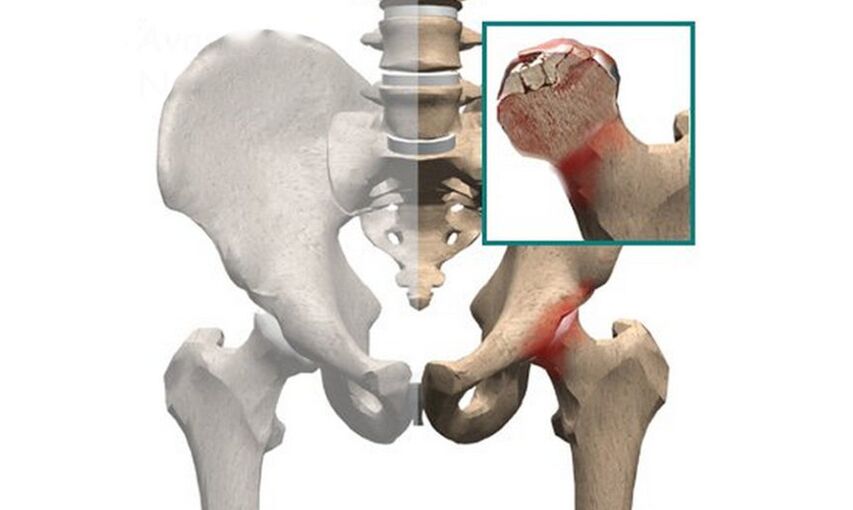 Nekróza hlavice stehenní kosti je jednou z příčin bolesti v kyčelním kloubu