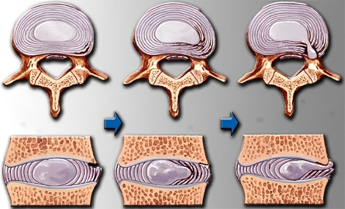 stádia osteochondrózy