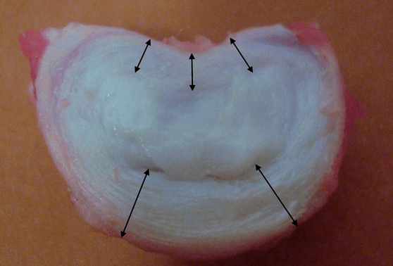 jak vypadá meziobratlová ploténka