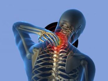 Člověka s osteochondrózou krční páteře trápí bolesti krku
