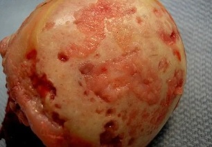 Postižená kloubní artrózou trpí chrupavky povrch